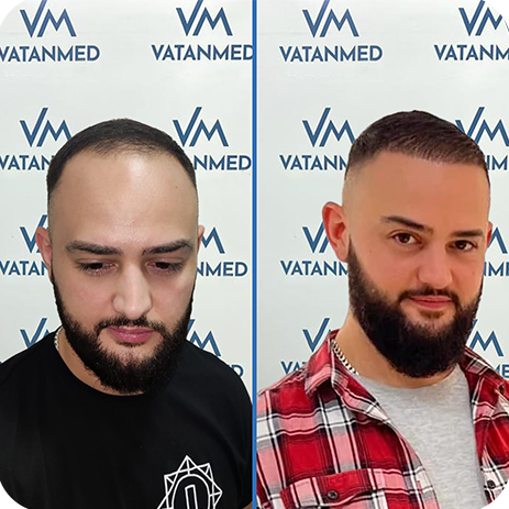 Haartransplantation