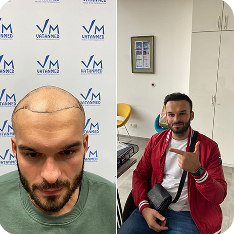 Was Während Der Erholung Nach Der Haartransplantation Zu Erwarten Ist?