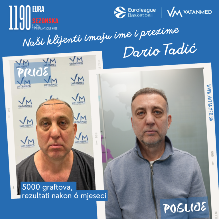 rezultati-transplantacije-kose-vatanmed-dario