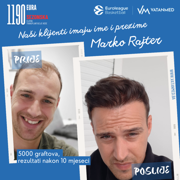 rezultati-transplantacije-kose-vatanmed-marko