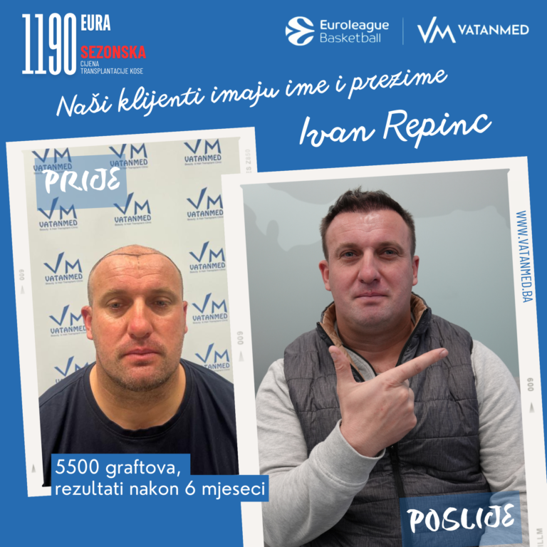 rezultati-transplantacije-kose-vatanmed-ivan