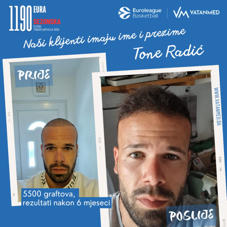 rezultati-transplantacije-kose-vatanmed-tone