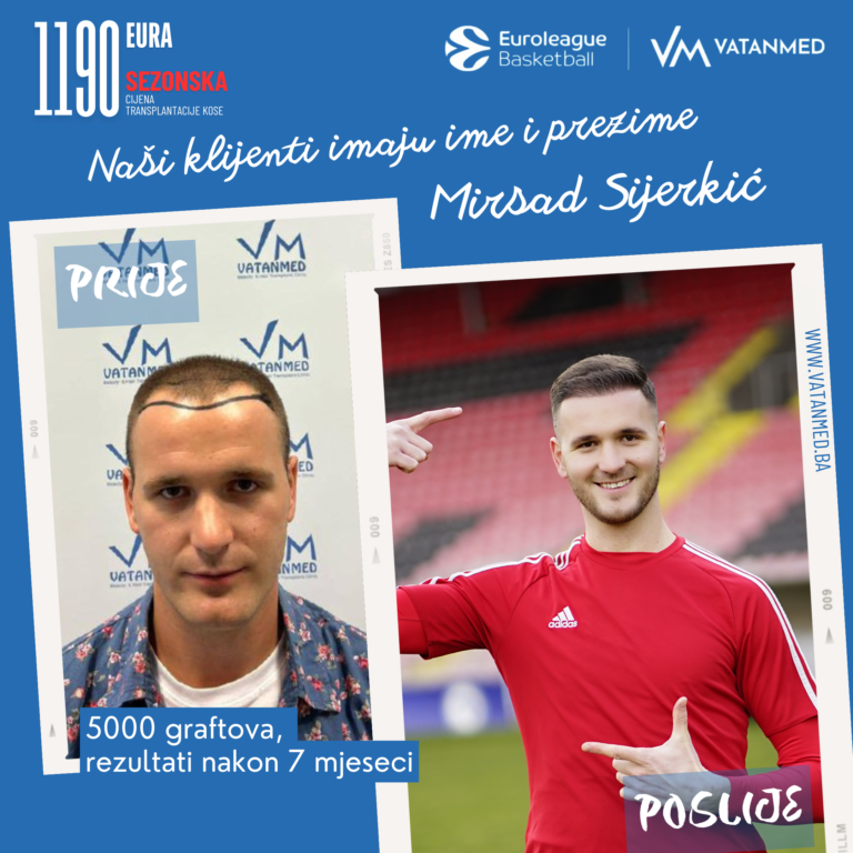 rezultati-transplantacije-kose-vatanmed-mirsad