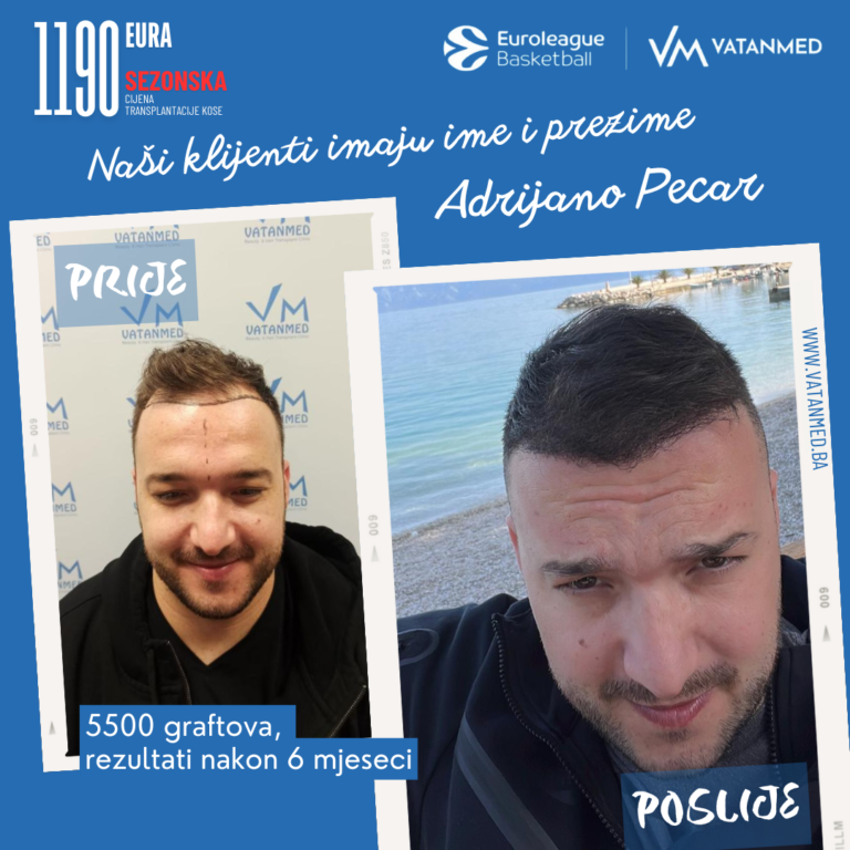 rezultati-transplantacije-kose-vatanmed-adrijano