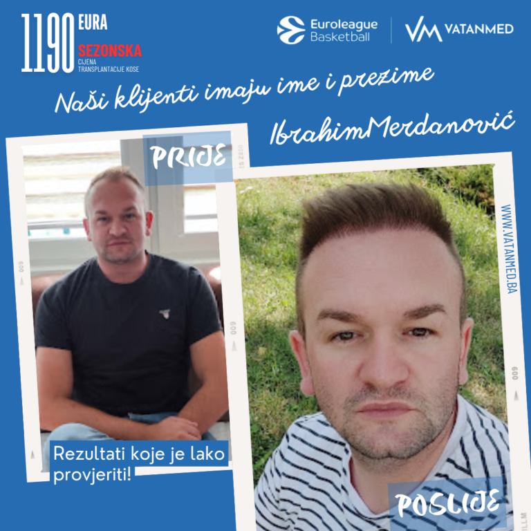 rezultati-transplantacije-kose-vatanmed-Ibrahim