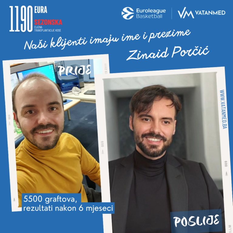 rezultati-transplantacije-kose-vatanmed-zinaid