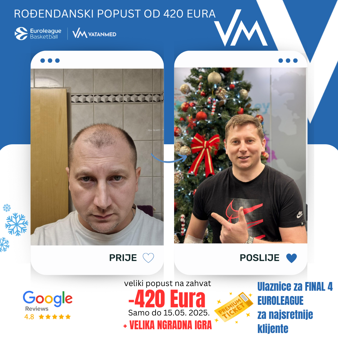 Rezultat transplantacije kose 3