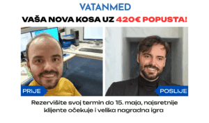 PRIJE i poslije transplatacije kose