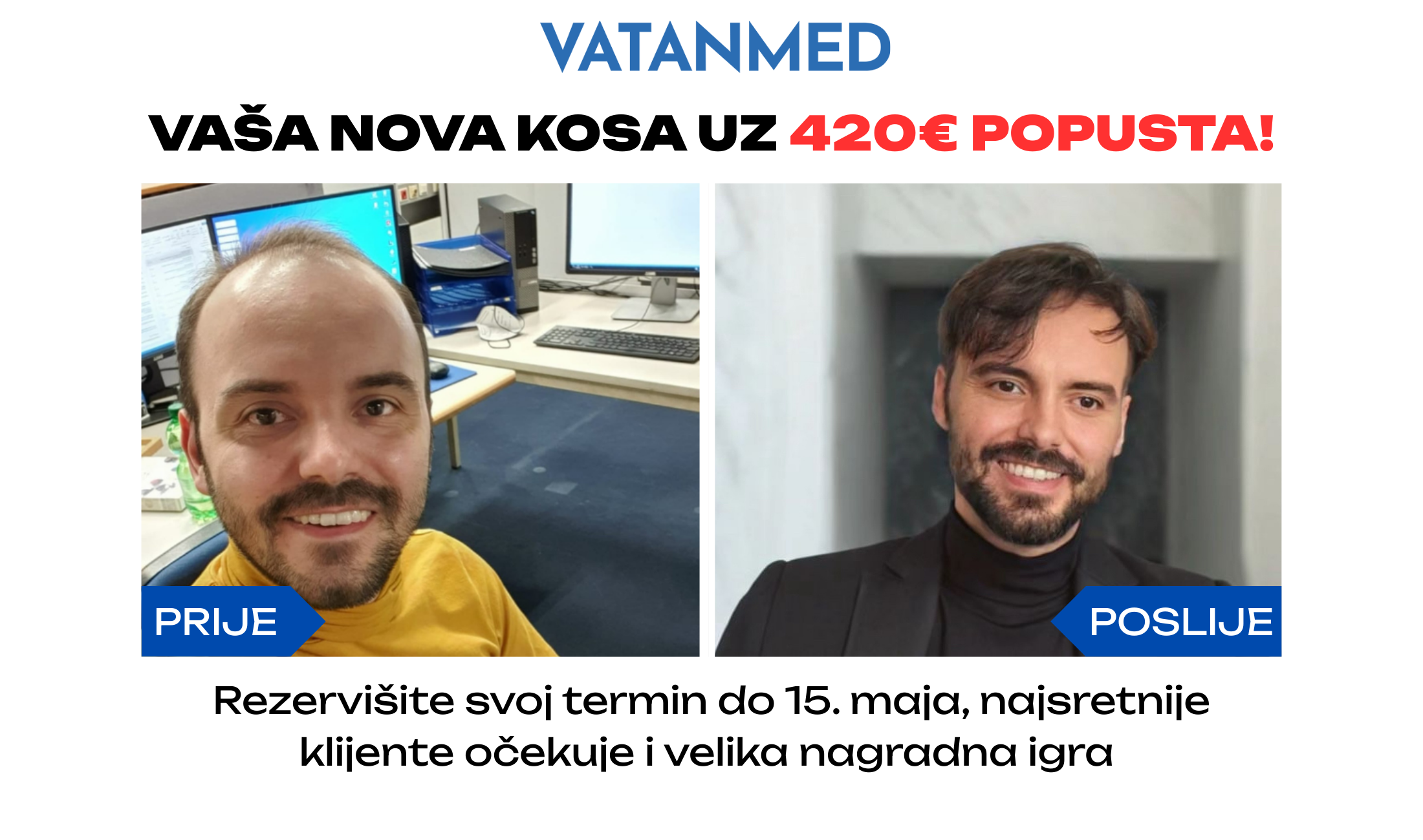 PRIJE i poslije transplatacije kose