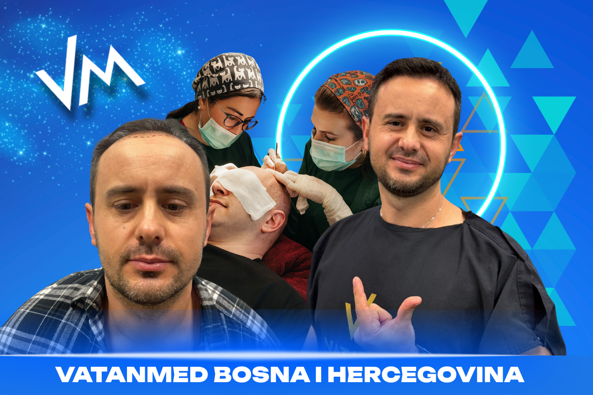 razlozi za transplantaciju kose