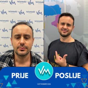 Prije i poslije transplantacije kose – rezultat 1