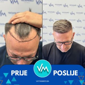 Prije i poslije transplantacije kose – rezultat 6
