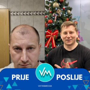 Prije i poslije transplantacije kose – rezultat 5