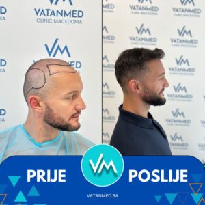 Prije i poslije transplantacije kose – rezultat 4