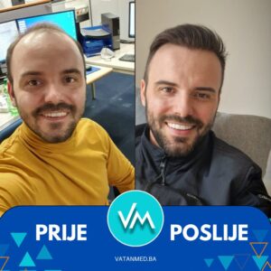 Prije i poslije transplantacije kose – rezultat 3