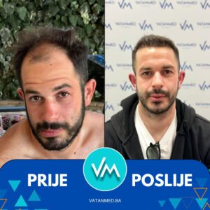 Prije i poslije transplantacije kose – rezultat 2