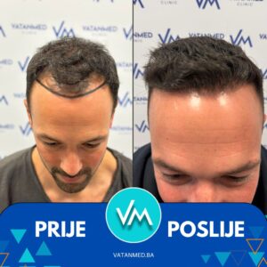 Prije i poslije transplantacije kose – rezultat 12