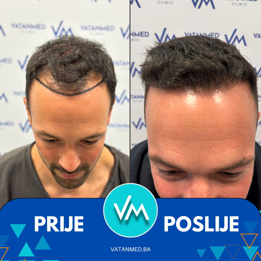 Rezultat transplantacije kose — pacijent VatanMed Sarajevo