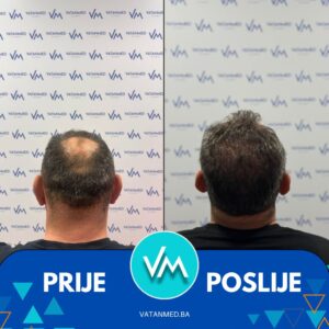 Prije i poslije transplantacije kose – rezultat 11