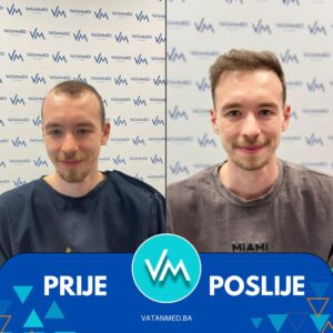 Prije i poslije transplantacije kose – rezultat 10