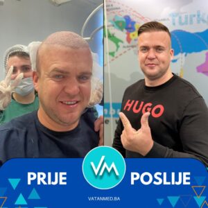 Prije i poslije transplantacije kose – rezultat 9