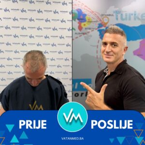 Prije i poslije transplantacije kose – rezultat 8