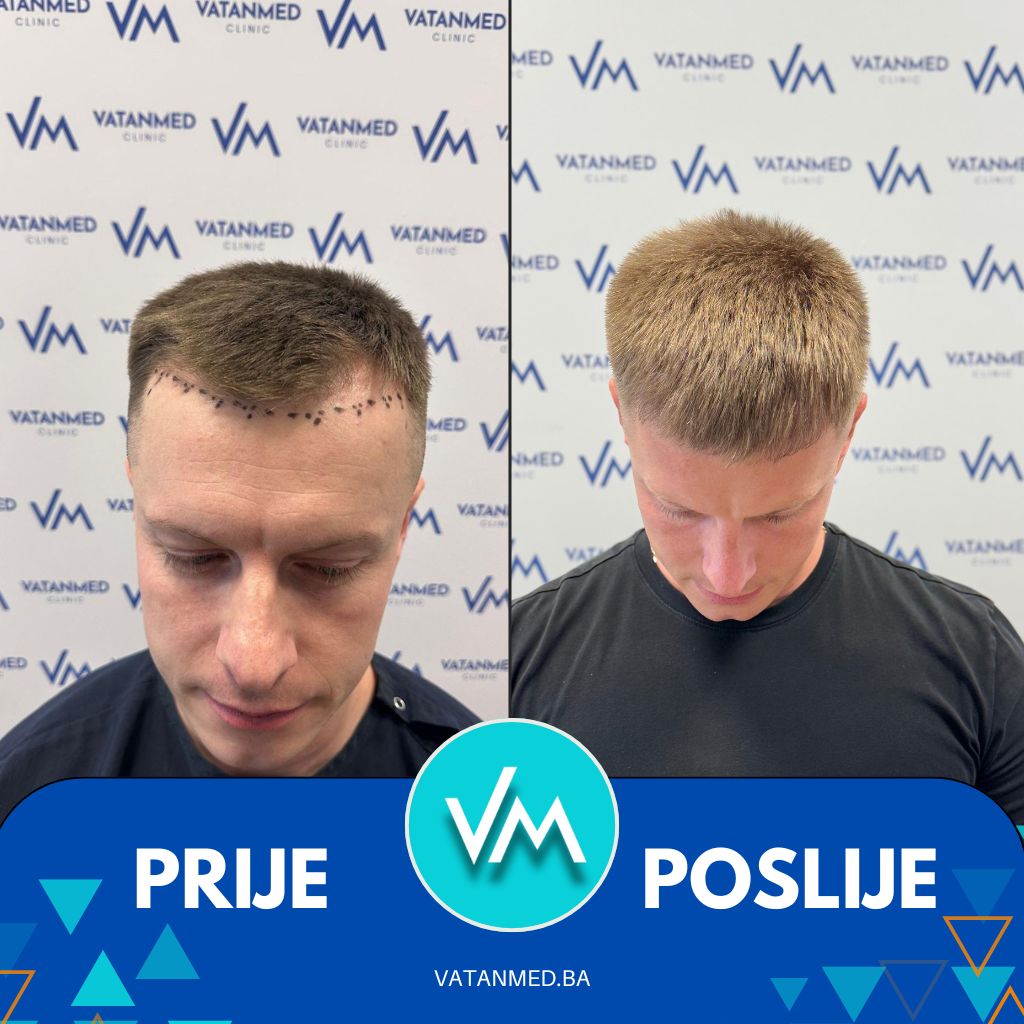 Rezultat transplantacije kose — pacijent VatanMed Sarajevo