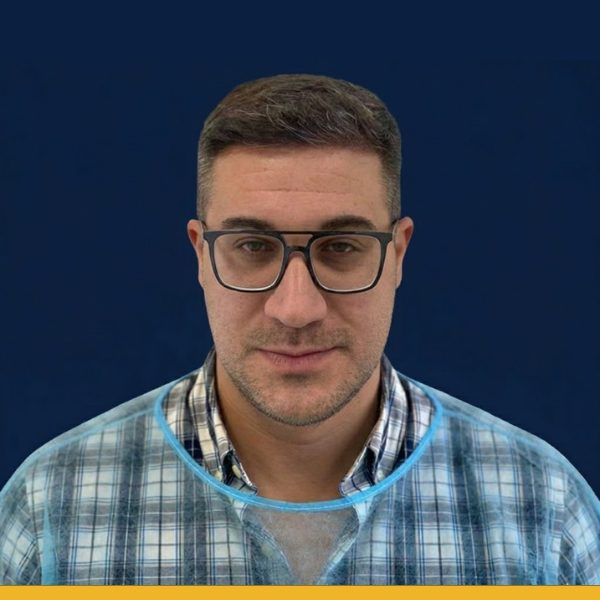 Poslije transplantacije kose s egzosomima — VatanMed Sarajevo