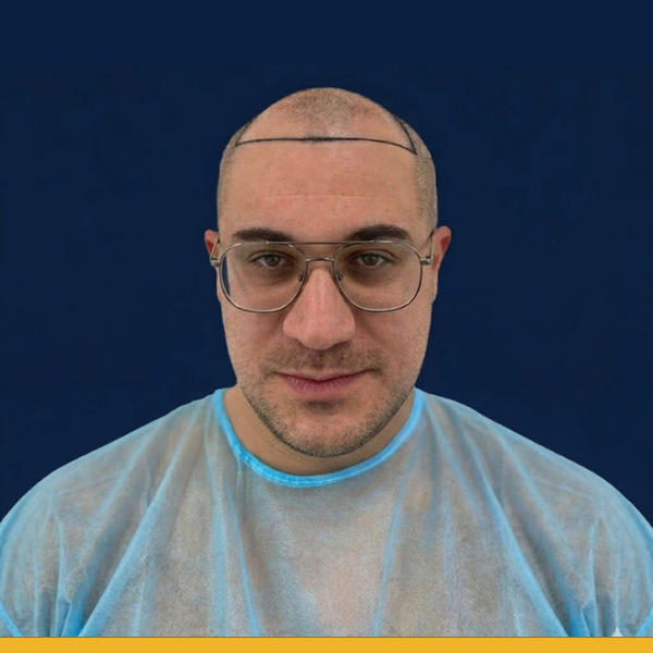 Prije transplantacije kose — VatanMed Sarajevo pacijent