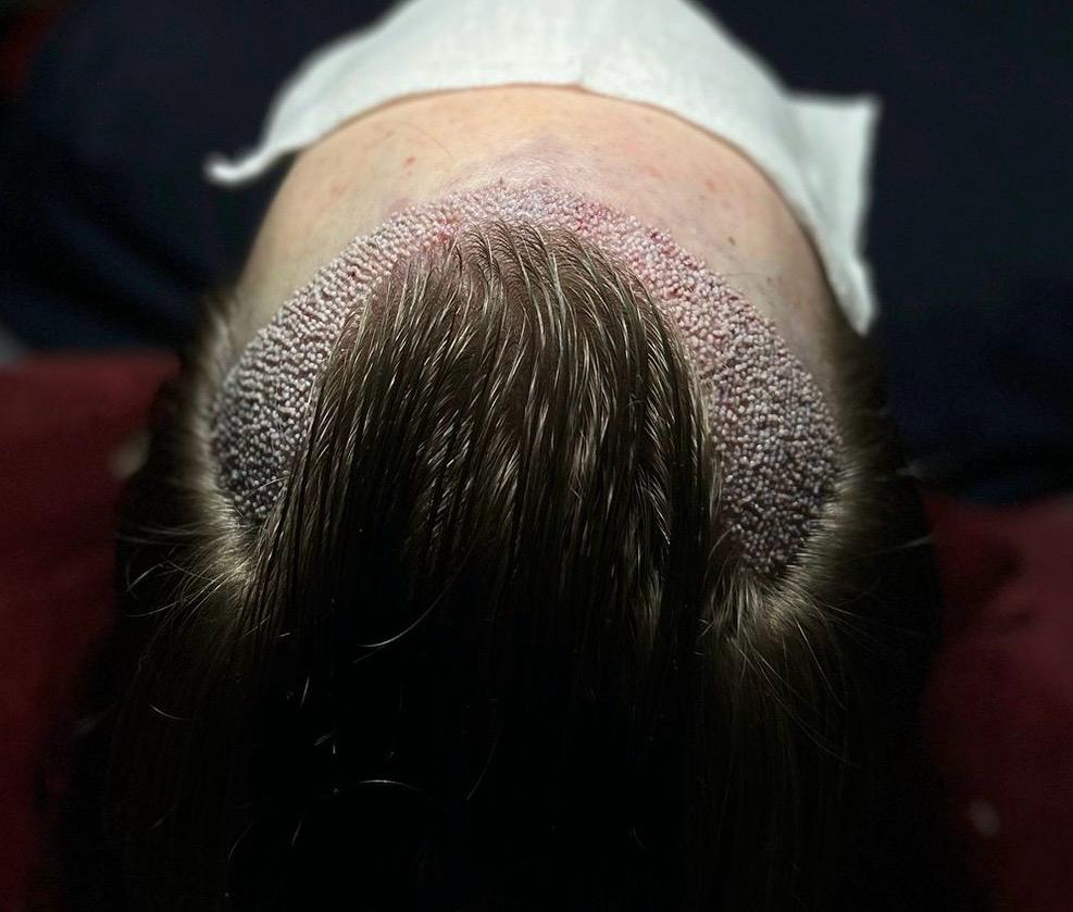 DHI metoda transplantacije kose bez šišanja – VatanMed Sarajevo