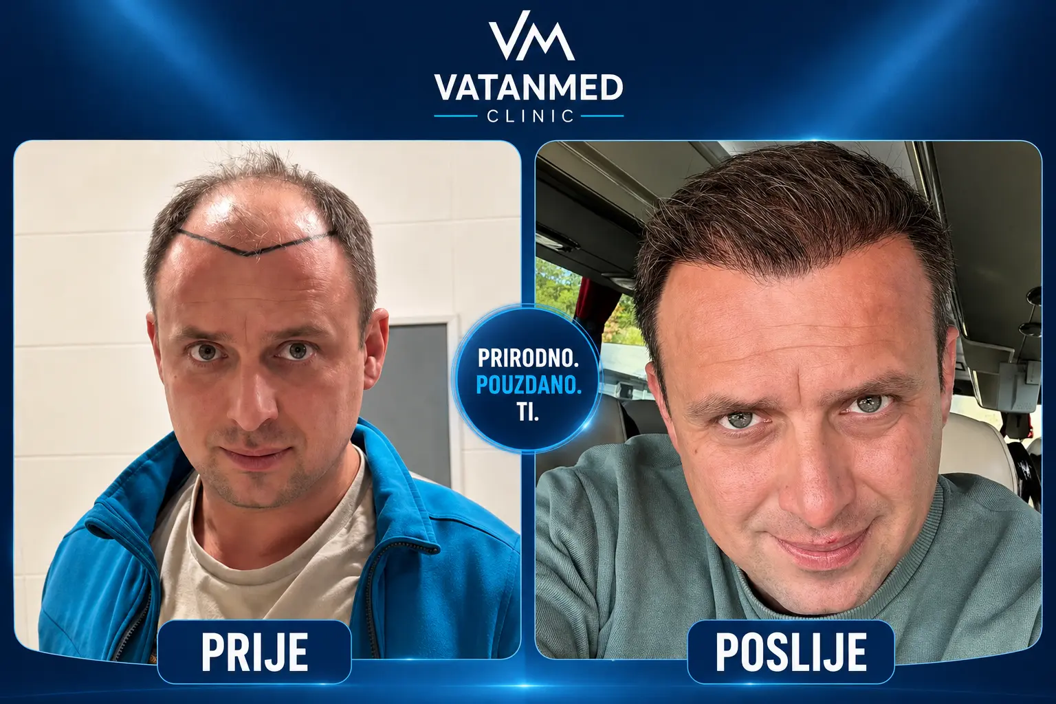 Ivan Vukelić — prije i poslije FUE transplantacije kose u VatanMed klinici, Sarajevo
